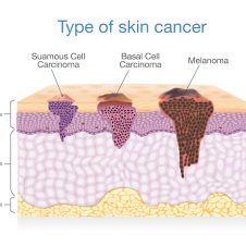 Skin Cancer: When Mohs Surgery is the Best Treatment - | - thirdAGE